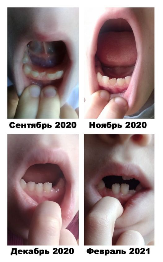 ДО и ПОСЛЕ – Выравнивание коренных зубок у ребенка.jpg