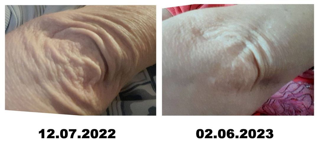 ДО и ПОСЛЕ – Локоть стал разглаживаться.jpg