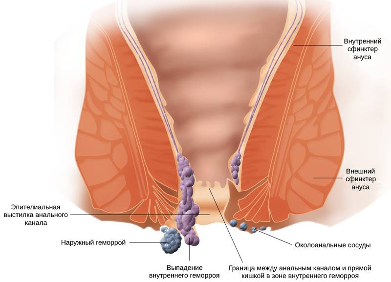 Поговорим о геморрое.jpg
