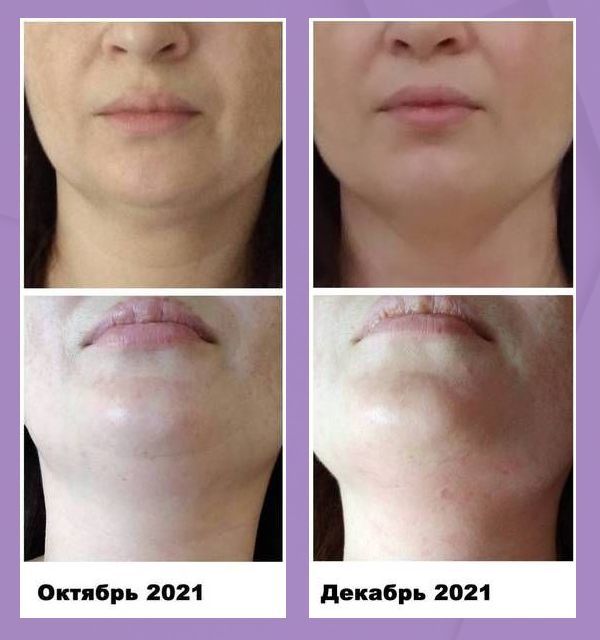 ДО и ПОСЛЕ – Лицо наполнилось и подтянулось.jpg