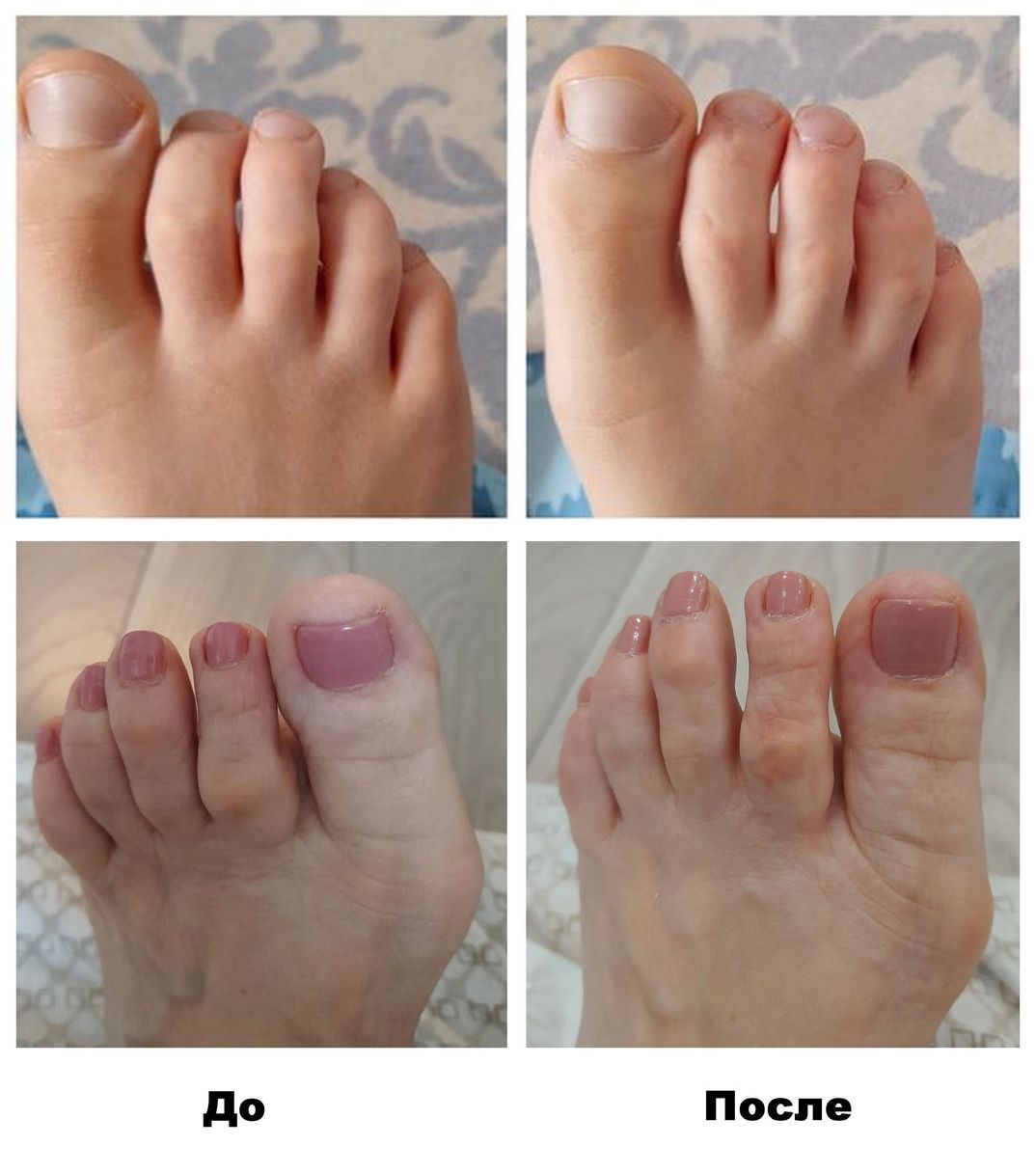 ДО и ПОСЛЕ – Выровнялись пальцы.jpg