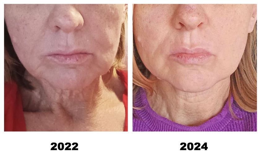 До и ПОСЛЕ – Восстанавливается эластичность шеи.jpg