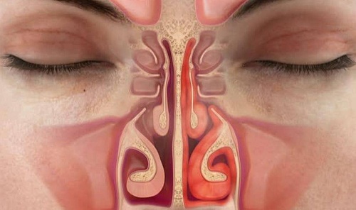 НАСМОРК... ЧТО ДЕЛАТЬ.jpg