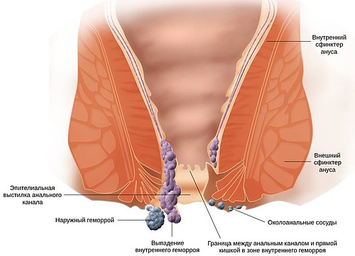 Поговорим о геморрое.jpg