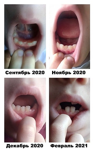 ДО и ПОСЛЕ – Выравнивание коренных зубок у ребенка.jpg