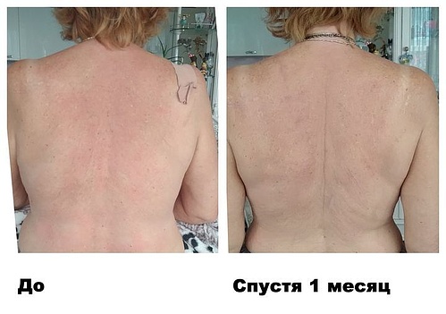 ДО и ПОСЛЕ – Спина стала ровнее и стройнее.jpg