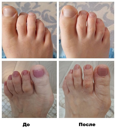 ДО и ПОСЛЕ – Выровнялись пальцы.jpg