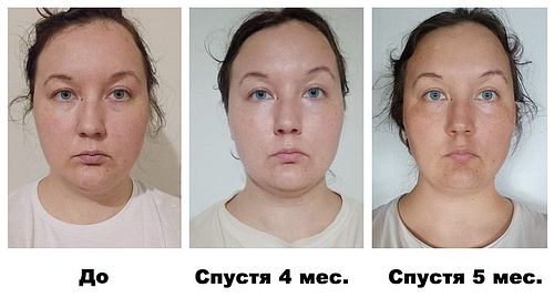 ДО и ПОСЛЕ – Эстетика лица и шеи.jpg