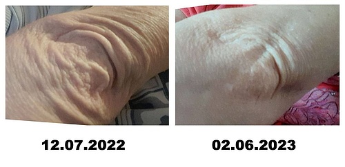 ДО и ПОСЛЕ – Локоть стал разглаживаться.jpg