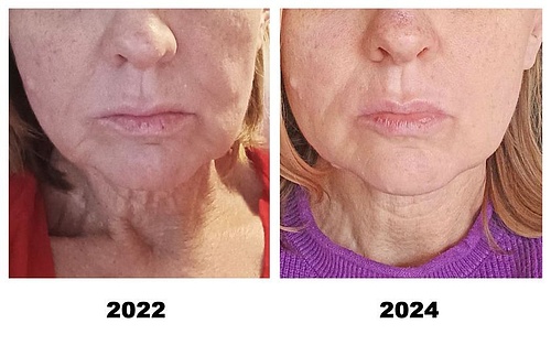 До и ПОСЛЕ – Восстанавливается эластичность шеи.jpg